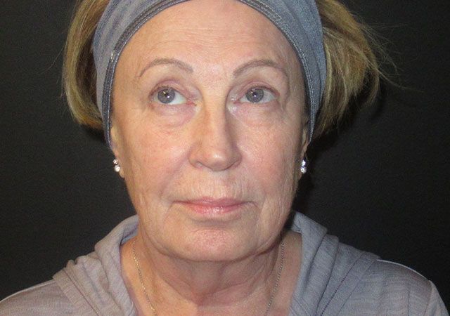 Chin Jawline Before & After