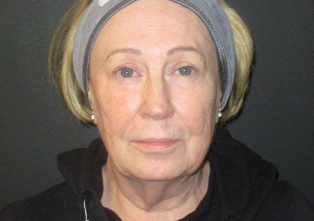 Chin Jawline Before & After