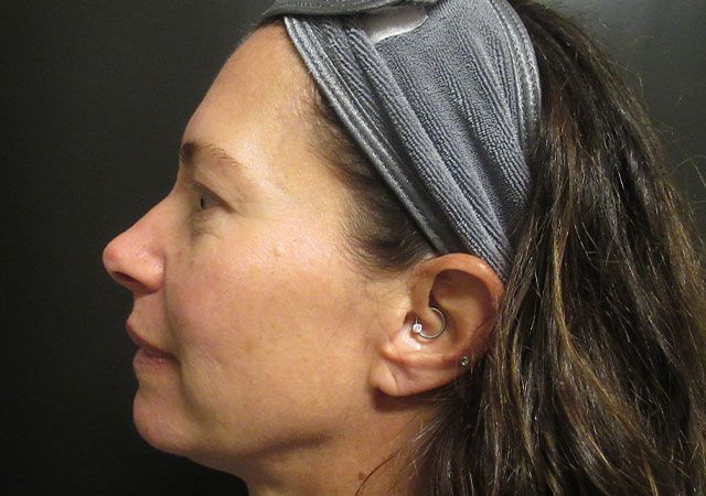 Chin Jawline Before & After