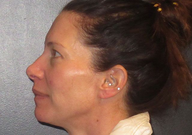 Chin Jawline Before & After