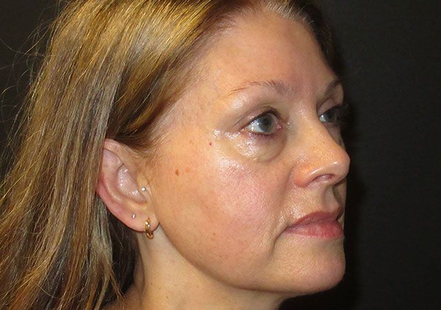 Chin Jawline Before & After