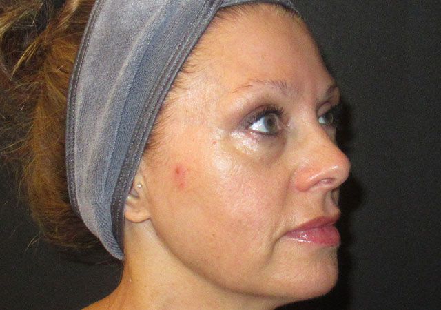 Chin Jawline Before & After