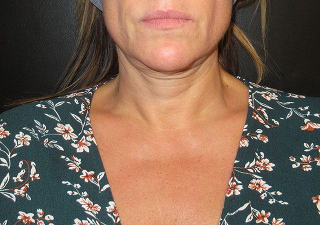 Chin Jawline Before & After