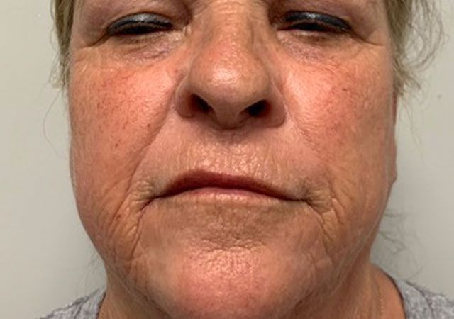 Chin Jawline Before & After