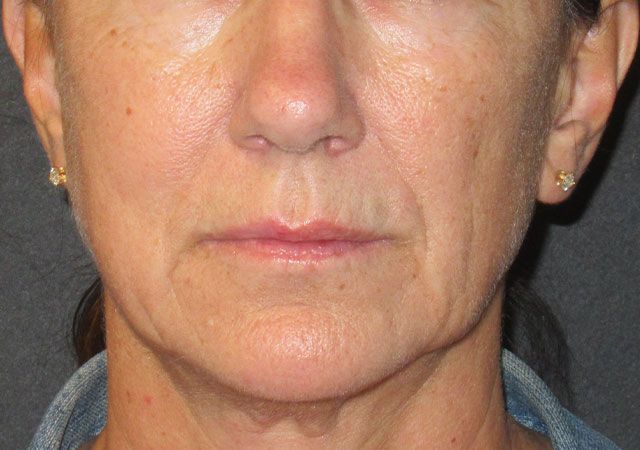 Chin Jawline Before & After