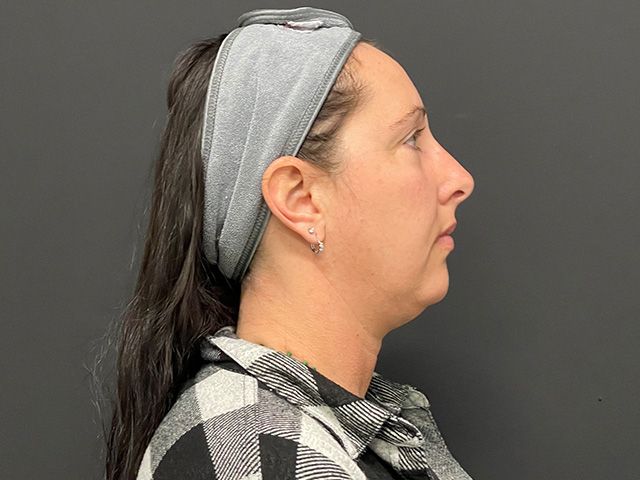 Chin Jawline Before & After