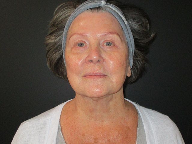 Chin Jawline Before & After