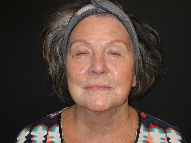 Chin Jawline Before & After