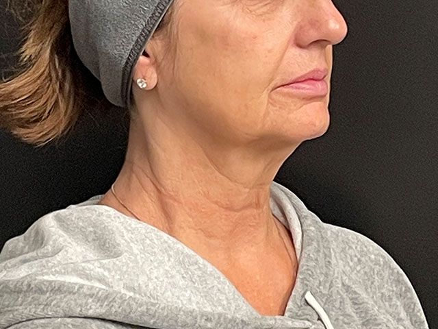 Chin Jawline Before & After