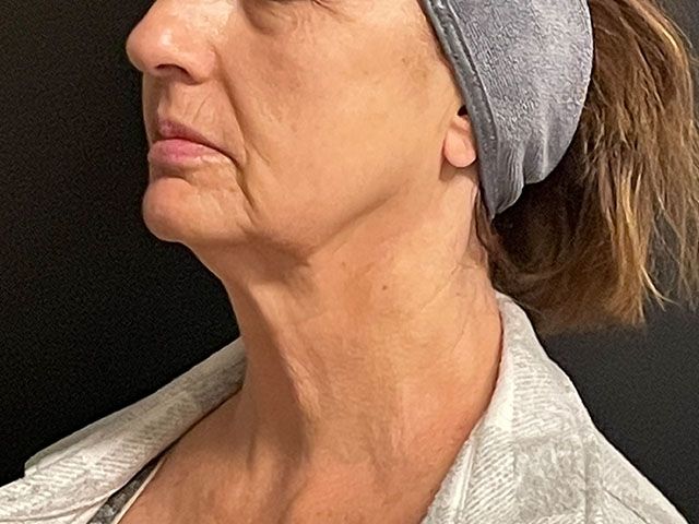 Chin Jawline Before & After