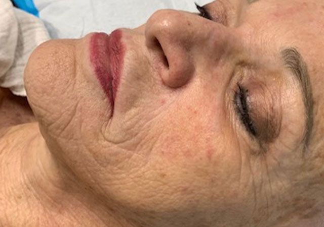 Chin Jawline Before & After