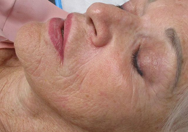 Chin Jawline Before & After