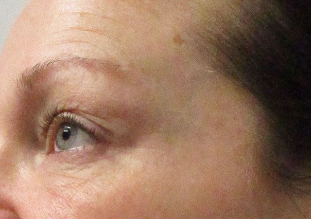 Chin Jawline Before & After