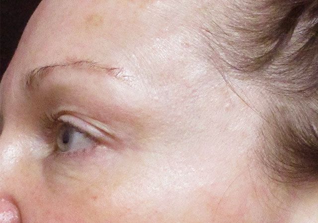 Chin Jawline Before & After