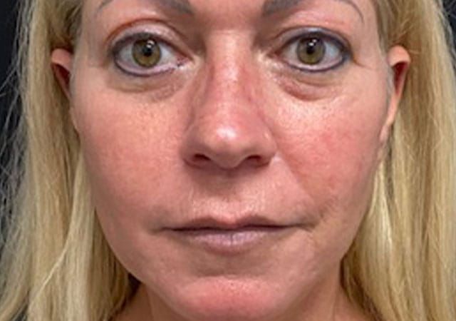 Chin Jawline Before & After