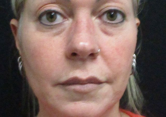 Chin Jawline Before & After