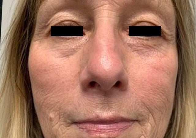 Chin Jawline Before & After