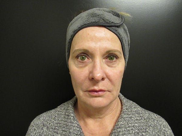 Chin Jawline Before & After