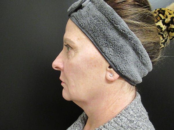 Chin Jawline Before & After