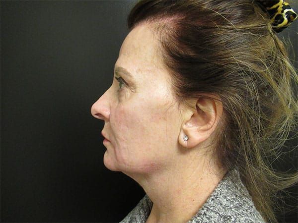 Chin Jawline Before & After