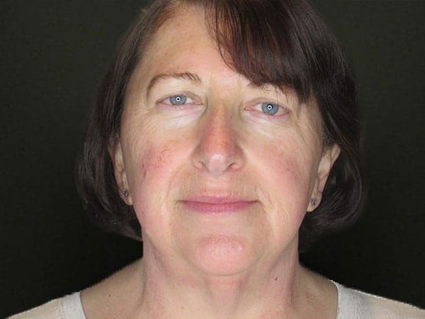 Chin Jawline Before & After