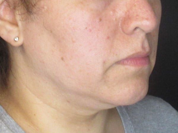 Chin Jawline Before & After