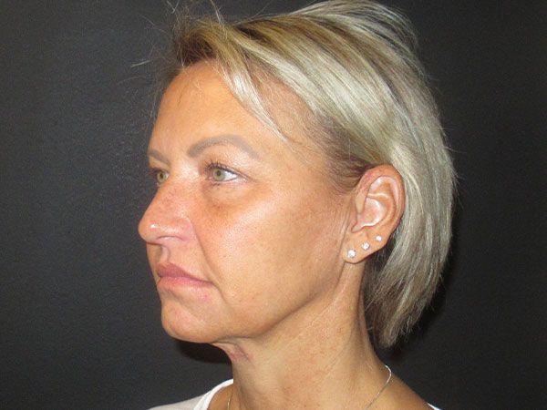 Chin Jawline Before & After