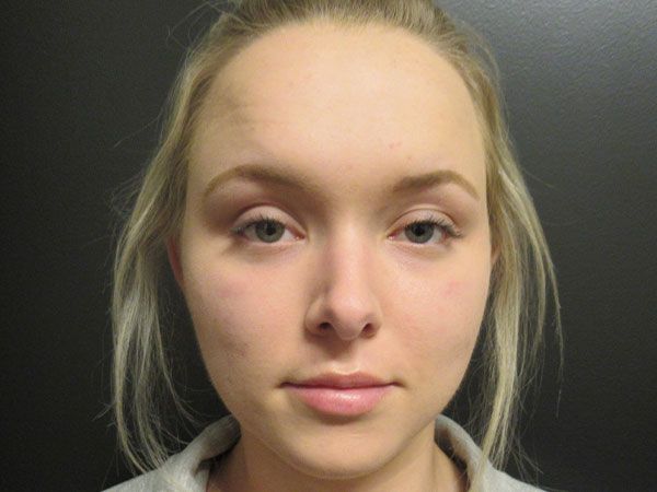 Chin Jawline Before & After