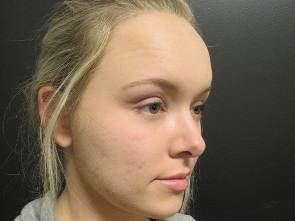 Chin Jawline Before & After