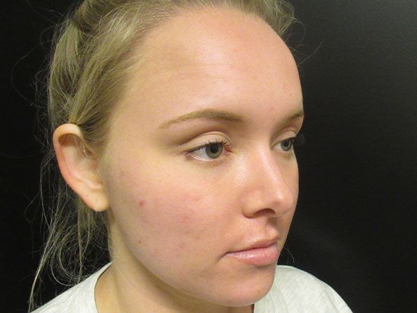 Chin Jawline Before & After