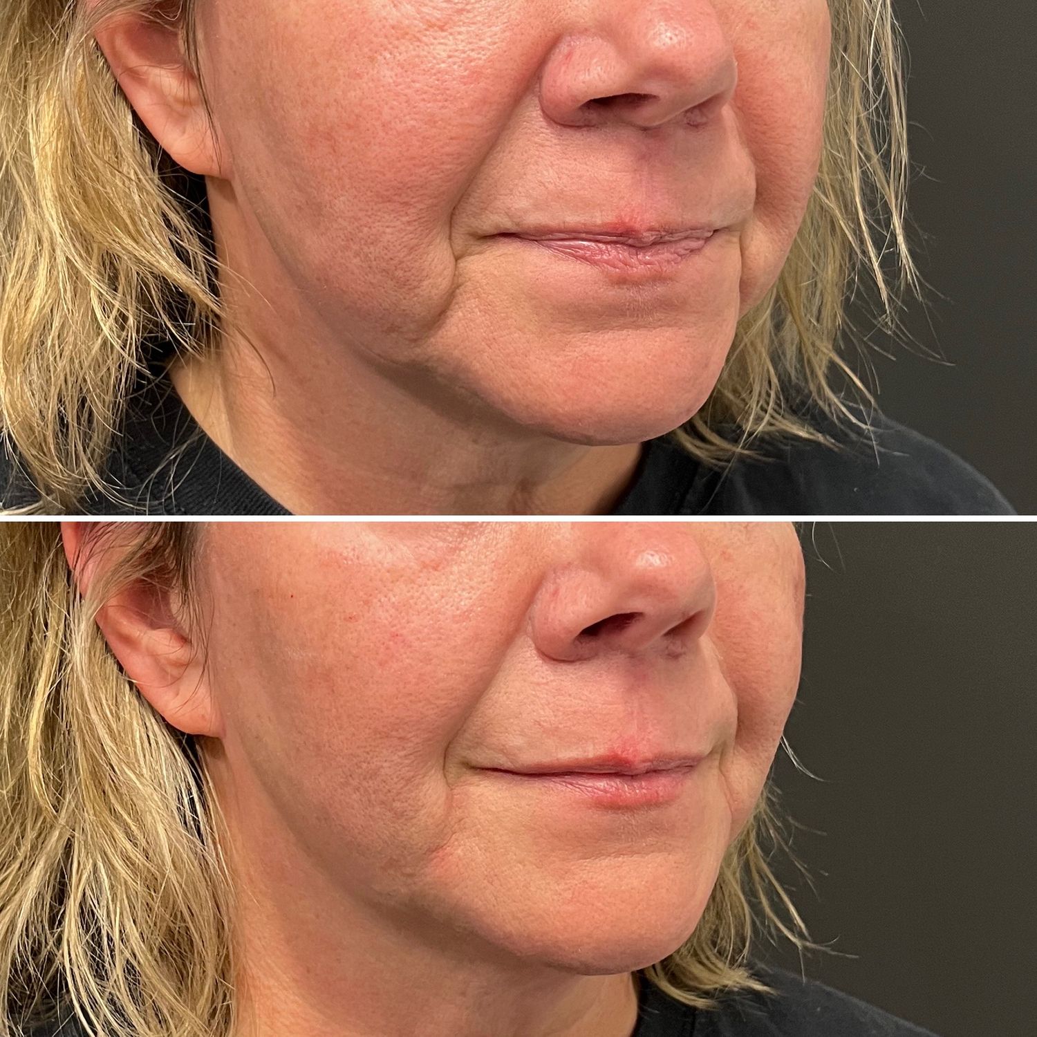 Chin & Jawline Enhancement Before & After