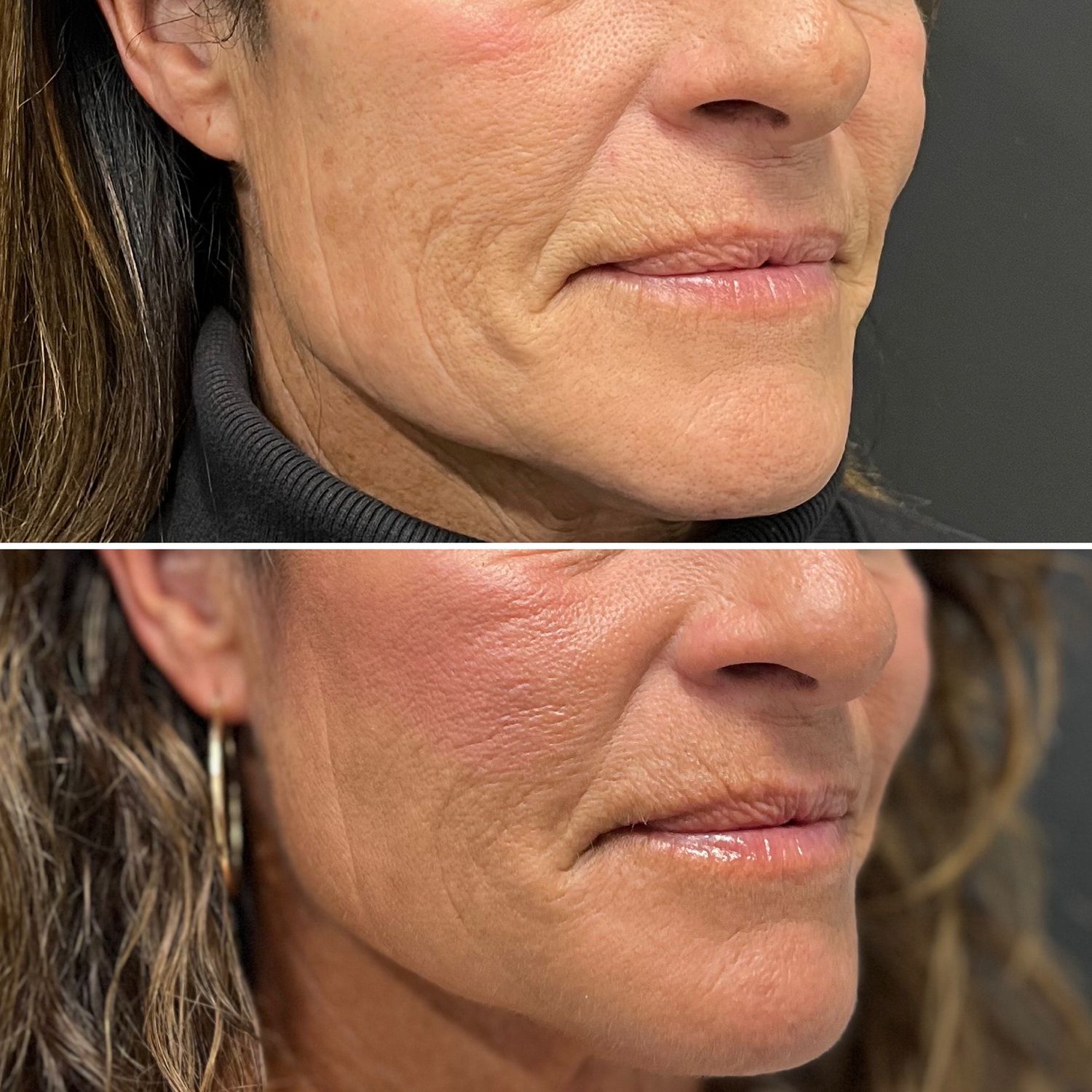 Chin & Jawline Enhancement Before & After