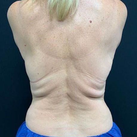 Coolsculpting Before & After