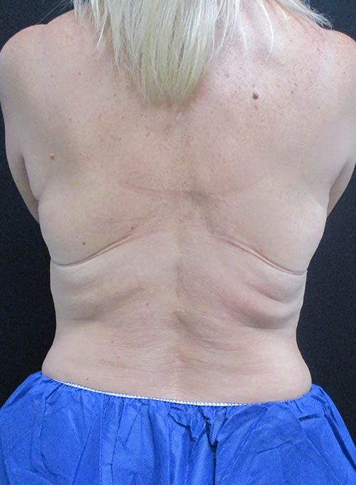 Coolsculpting Before & After