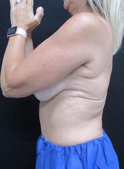 Coolsculpting Before & After