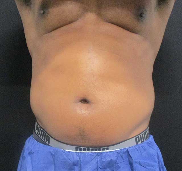 Coolsculpting Before & After