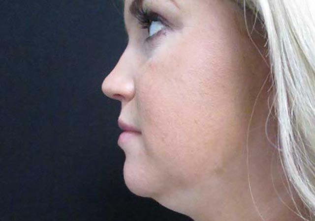 Coolsculpting Before & After