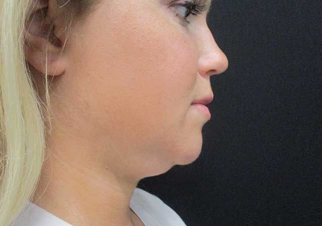 Coolsculpting Before & After