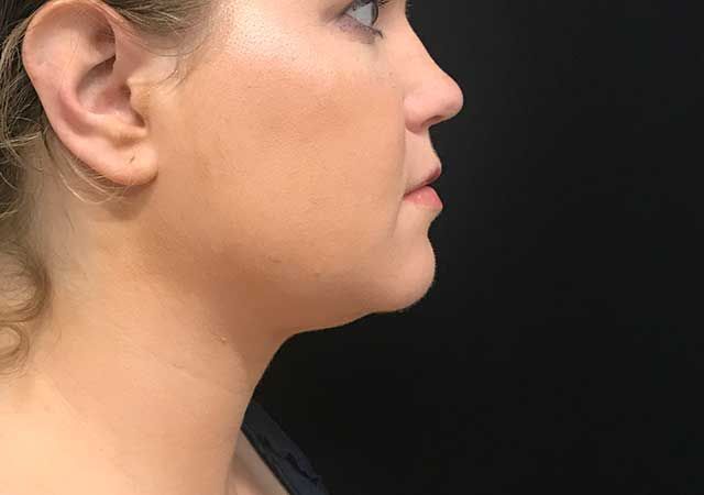 Coolsculpting Before & After