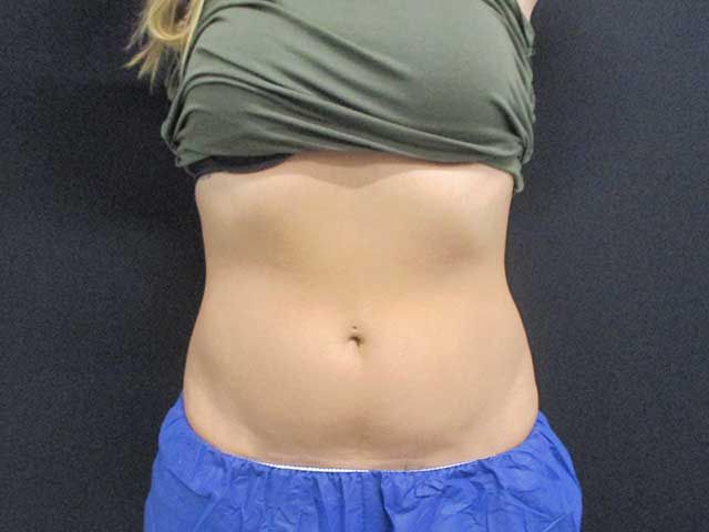 Coolsculpting Before & After