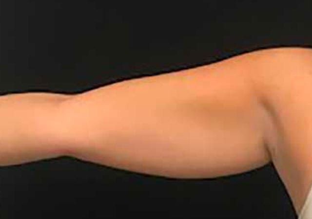 Coolsculpting Before & After