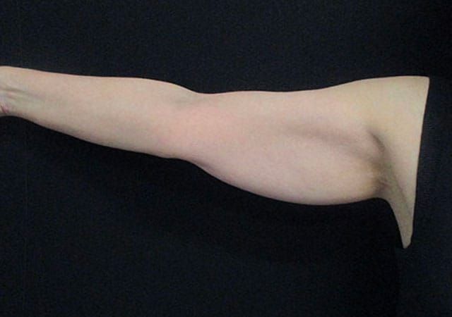 Coolsculpting Before & After