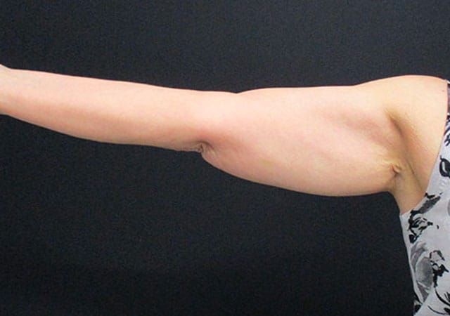 Coolsculpting Before & After