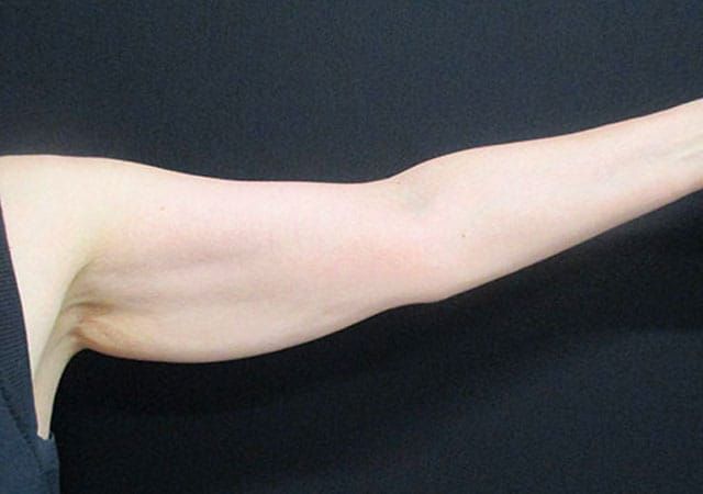 Coolsculpting Before & After