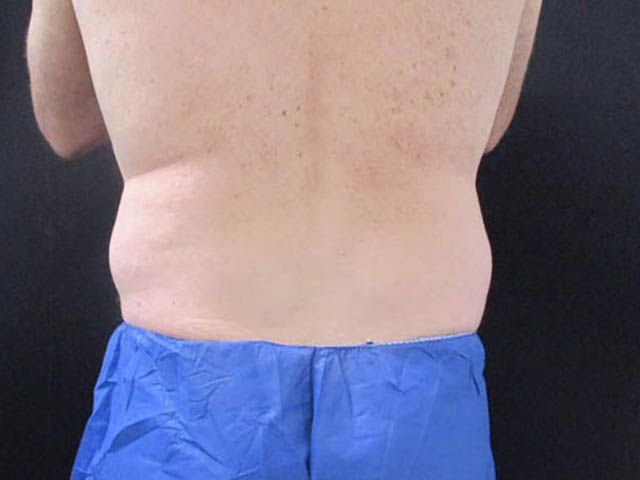 Coolsculpting Before & After