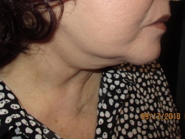 Coolsculpting Before & After