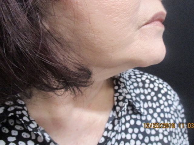 Coolsculpting Before & After