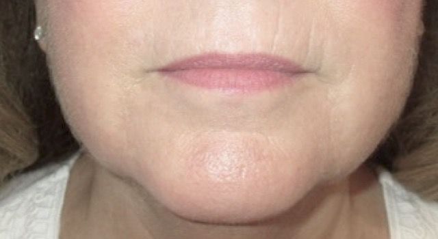 Coolsculpting Before & After