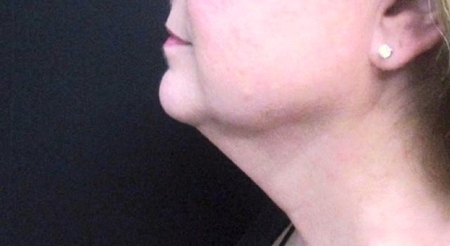 Coolsculpting Before & After