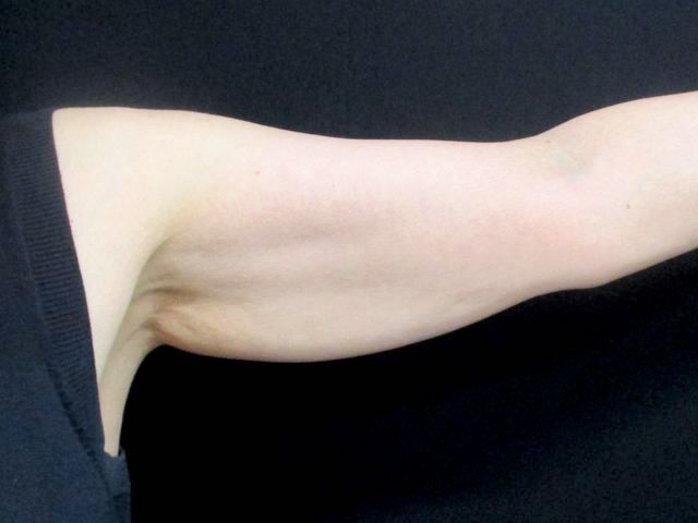 Coolsculpting Before & After